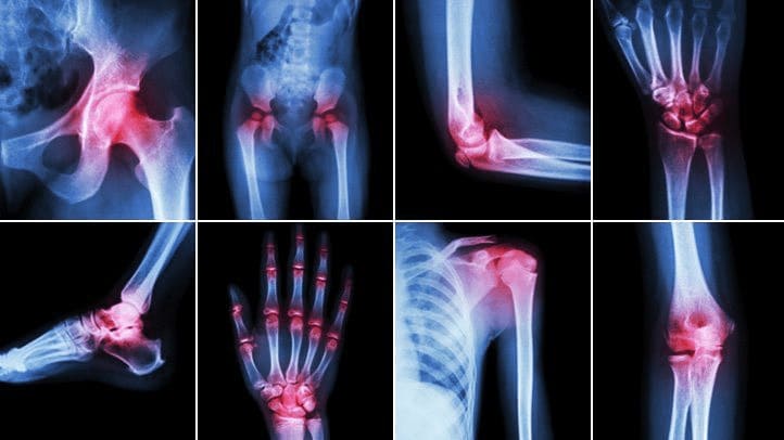 Joints of the Body Affected by Arthritis