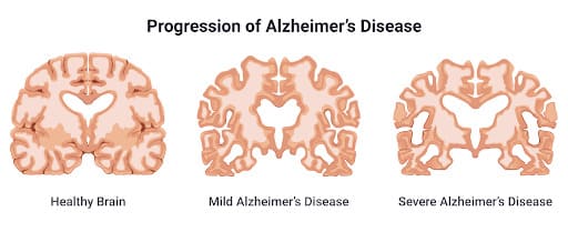 Progression of Alzheimer‘s Disease