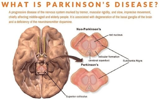 What is Parkinson Disease